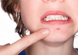 Как избавиться от прыщей?